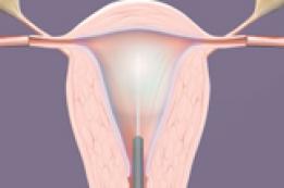 Endometrial Ablation