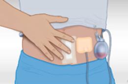 Caring for a Drain After Surgery