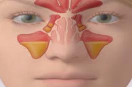 Acute Sinusitis