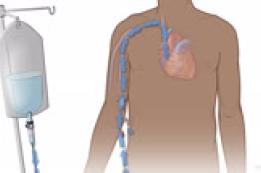 Getting Treatment Through a PICC or Central Line