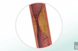 Cardiac ischemia: Fast Facts